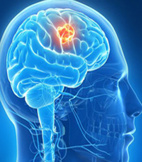What are the benefits of selecting the top brain surgeon in Bangalore?